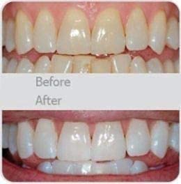 V-White Electric Toothbrush Adults - Ultrasonic U-Shaped Toothbrushes For Teeth Whitening - 360