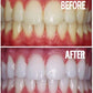 Bright White Smiles - Teeth Whitening Gel Refill Kit - 10 Tubes 44% Carbamide Peroxide Tooth Whitener Formula